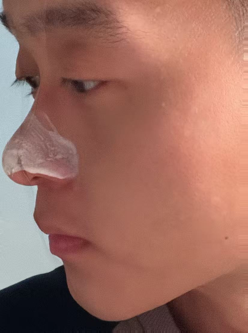 Thai Aloe Vera Blackhead Remover